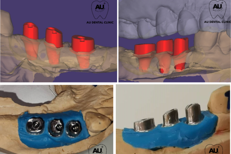 What is a ‘Customized Abutment’? AU Dental
